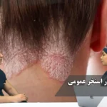 بیماری پوستی در استخر عمومی – قسمت دوم