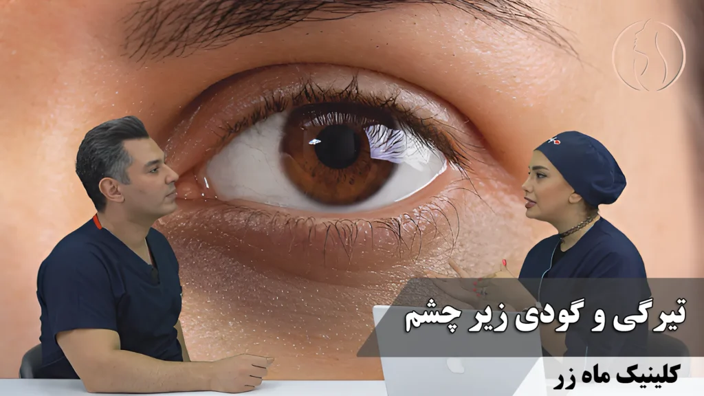 تیرگی و گودی زیر چشم