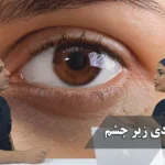 تیرگی و گودی زیر چشم