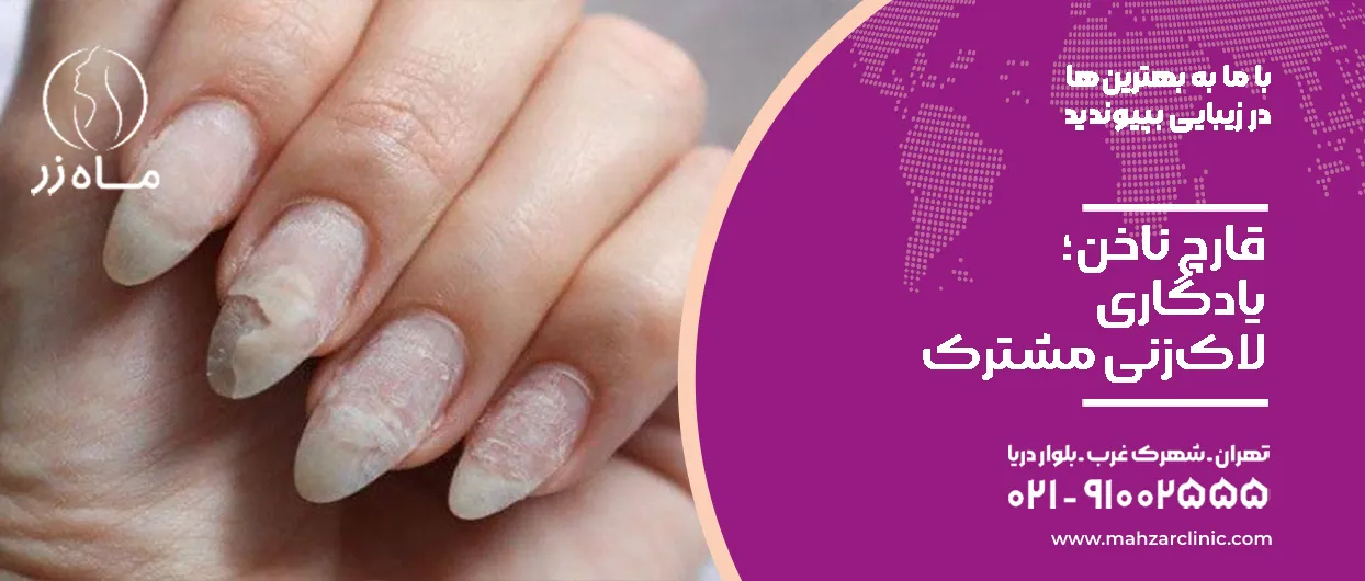قارچ ناخن؛ یادگاری لاک‌زنی مشترک