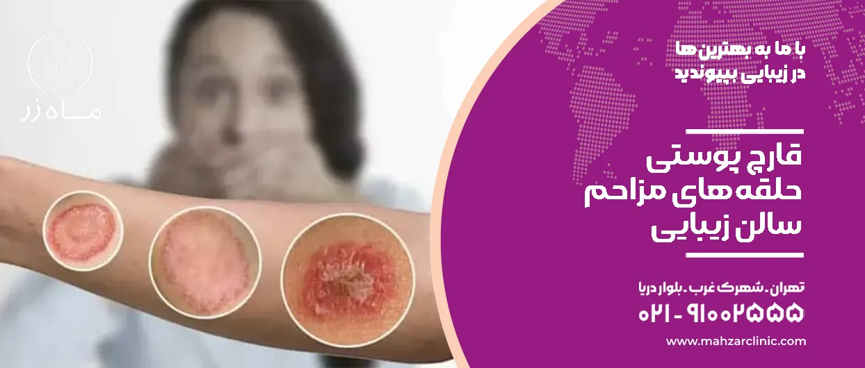 قارچ پوستی؛ حلقه‌های مزاحم سالن زیبایی